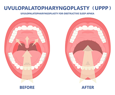 Illustration of a mouth before and after a surgical sleep apnea treatment