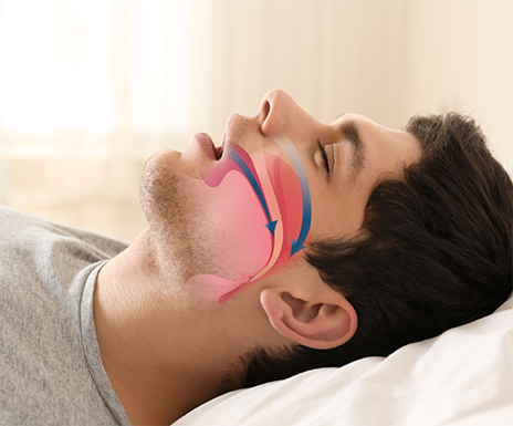 Man sleeping on his back with his mouth open and his blocked airway illustrated